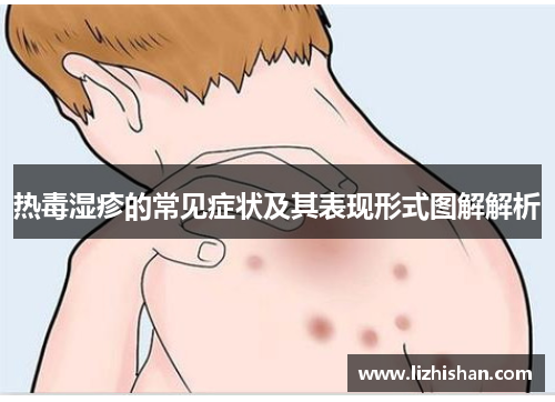 热毒湿疹的常见症状及其表现形式图解解析
